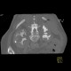 Postpyelonephritic changes, nephrolithiasis, kidney stones: CT - Computed tomography